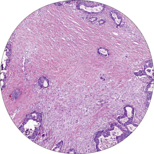 Stroma-high tumour