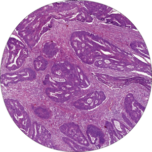 Stroma-low tumour